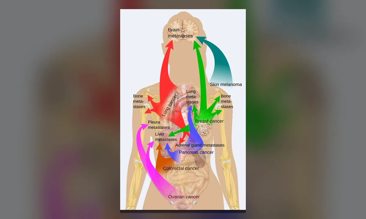 Imagen principal sobre La metástasis