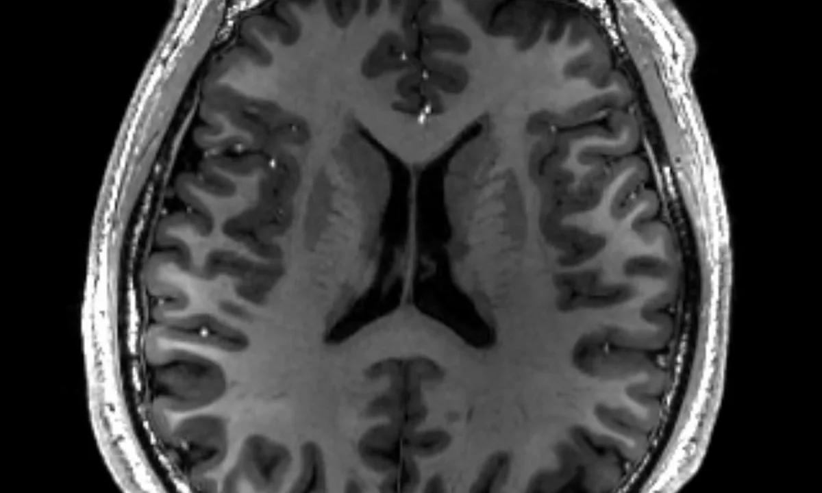 Resonancia magnética real de un cerebro humano